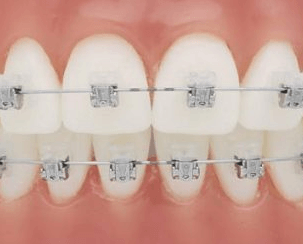 Brackets autoligantes